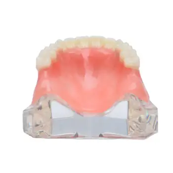 1 vnt dantų Implantai, Dantų Modelio Overdenture Restauravimo Aišku 6001 Viršutinės 6003 Mažesnis 6002 Mažesnis Implantsmaxillary /keičia apatinio žandikaulio