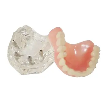 1 vnt dantų Implantai, Dantų Modelio Overdenture Restauravimo Aišku 6001 Viršutinės 6003 Mažesnis 6002 Mažesnis Implantsmaxillary /keičia apatinio žandikaulio